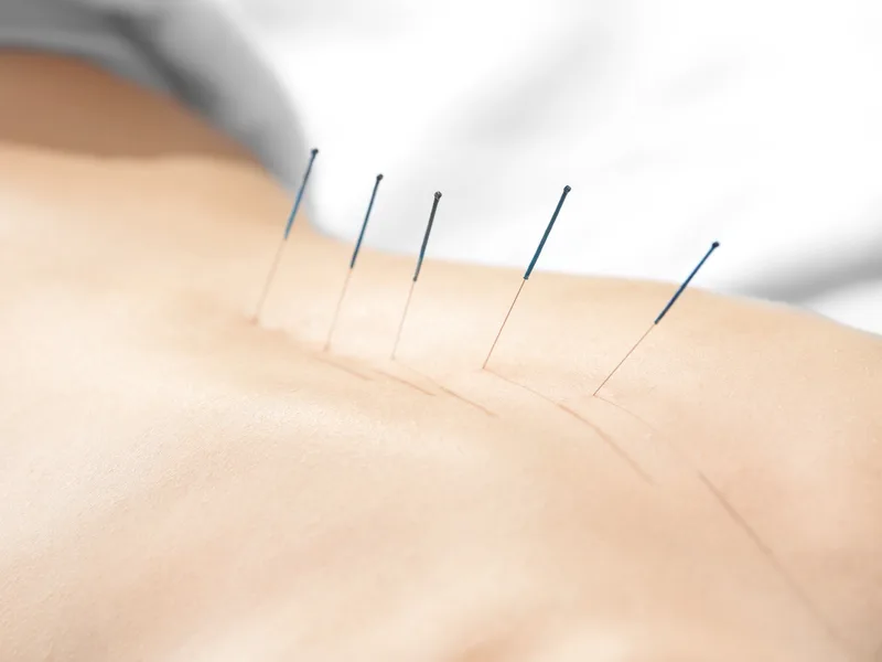 Acupuncture at Total Balance Chiropractic in Chicago