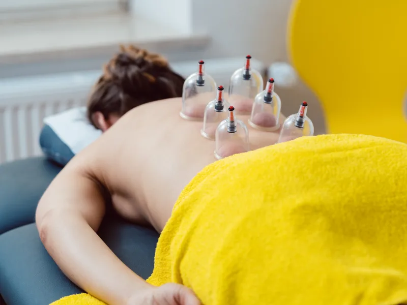 Cupping Therapy at Total Balance Chiropractic in Chicago