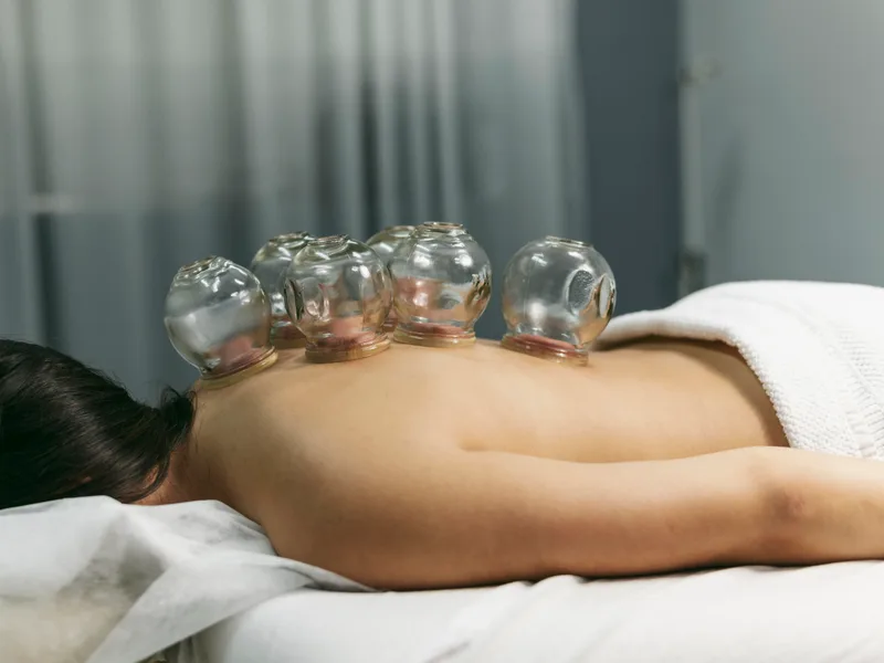 Cupping Therapy at Total Balance Chiropractic in Chicago