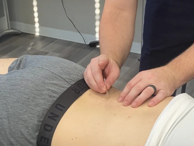 How Dry Needling works at Total Balance Chiropractic