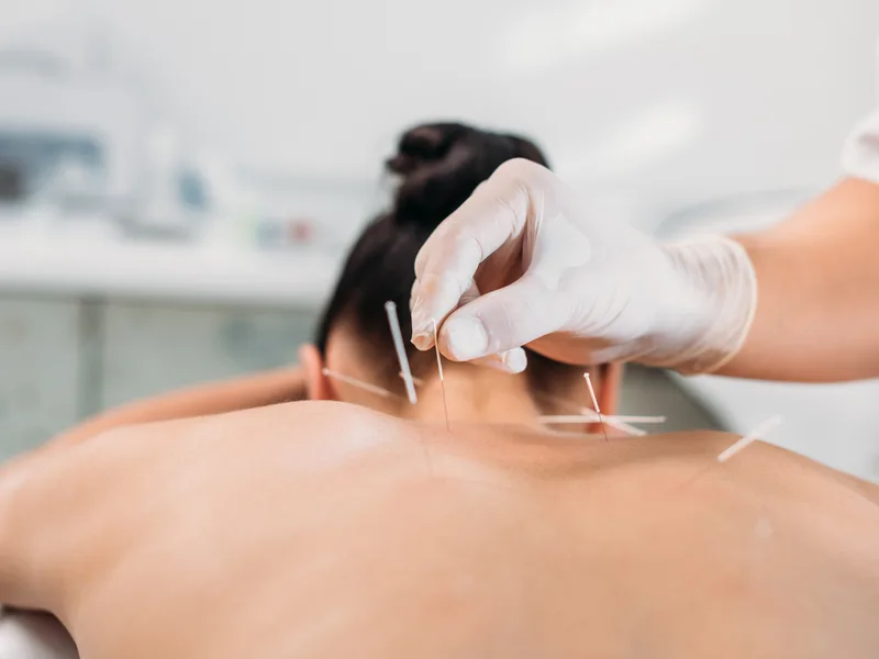 Dry Needling at Total Balance Chiropractic in Chicago